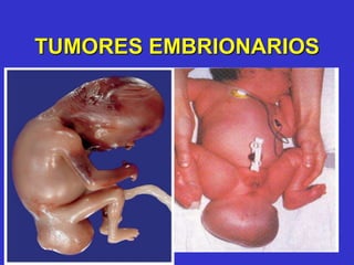 TUMORES EMBRIONARIOS
 