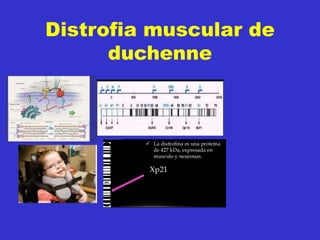 Distrofia muscular de
duchenne
 