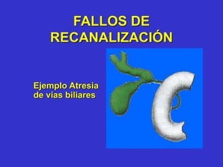 FALLOS DE
RECANALIZACIÓN
Ejemplo Atresia
de vías biliares
 