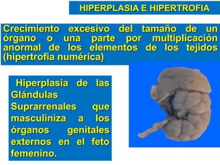 HIPERPLASIA E HIPERTROFIA
Crecimiento excesivo del tamaño de un
órgano o una parte por multiplicación
anormal de los elementos de los tejidos
(hipertrofia numérica)
Hiperplasia de las
Glándulas
Suprarrenales que
masculiniza a los
órganos genitales
externos en el feto
femenino.
 