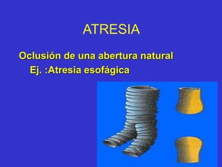 ATRESIA
Oclusión de una abertura natural
Ej. :Atresia esofágica
 