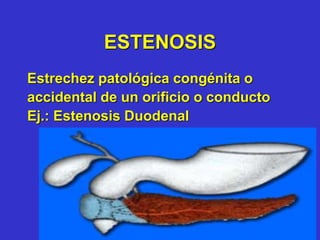ESTENOSIS
Estrechez patológica congénita o
accidental de un orificio o conducto
Ej.: Estenosis Duodenal
 