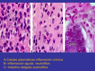 A-Celulas plasmáticas inflamación crónica
B- Inflamación aguda neutrófilos
C- Intestino delgado eosinofilos
 