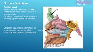 CORTE
SAGITAL
Normas del cráneo
Cavidad nasal
En esta imagen se observa la pared
lateral de las fosas nasales, que es la
más compleja.
Se pueden identificar los huesos que la
forman y algunos senos paranasales.
Utilizando esta imagen, identifique los
huesos que forman las paredes
superior e inferior de la cavidad nasal. Concha nasal inferior
maxilar palatino
etmoides
nasal
esfenoides
Seno frontal
Seno esfenoidal
lagrimal
 