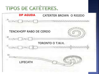 CATERTER BROWN O RIGIDO
TENCKHOFF RABO DE CERDO
TORONTO O T.W.H.
LIFECATH
DP AGUDA
 