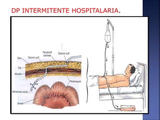 DP INTERMITENTE HOSPITALARIA.
 