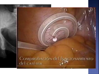 Por punción
 No anestesia general
 Nefrólogo
 No quirófano
 Colocación a ciegas
 No control de
complicaciones
Por laparoscopia
 Visualización abdominal
 Control de complicaciones
 Adecuada colocación
 Anestesia general
 Cirujano entrenado
 Quirófano
 