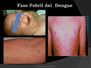 Fase Febril del Dengue
33LUZ M.JORGE (Medico Interno)
 