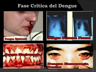 Fase Crítica del Dengue
35LUZ M.JORGE (Medico Interno)
 
