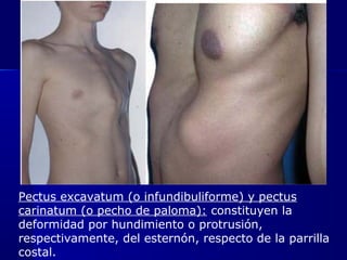 Pectus excavatum (o infundibuliforme) y pectus
carinatum (o pecho de paloma): constituyen la
deformidad por hundimiento o protrusión,
respectivamente, del esternón, respecto de la parrilla
costal.
 