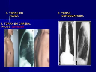 4. TORAX EN CARENA.
Pectus carinatum
5. TORAX
ENFISEMATOSO.
3. TORAX EN
FALDA.
 