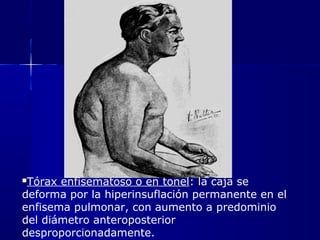 Tórax enfisematoso o en tonel: la caja se
deforma por la hiperinsuflación permanente en el
enfisema pulmonar, con aumento a predominio
del diámetro anteroposterior
desproporcionadamente.
 