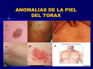 ANOMALIAS DE LA PIEL
DEL TORAX
1. 2.
3.
4. 5. 6.
 