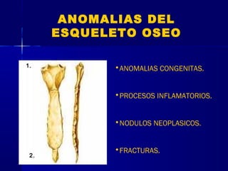 ANOMALIAS DEL
ESQUELETO OSEO
1. •ANOMALIAS CONGENITAS.
•PROCESOS INFLAMATORIOS.
•NODULOS NEOPLASICOS.
•FRACTURAS.
2.
 