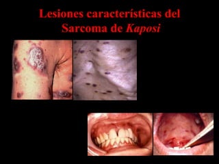 Lesiones características del
    Sarcoma de Kaposi
 