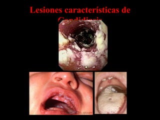 Lesiones características de
       Candidiasis
 