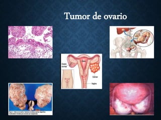 Tumor de ovario
 