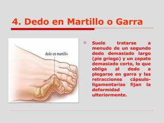 4. Dedo en Martillo o Garra
 Suele tratarse a
menudo de un segundo
dedo demasiado largo
(pie griego) y un zapato
demasiado corto, lo que
obliga al dedo a
plegarse en garra y las
retracciones cápsulo-
ligamentarias fijan la
deformidad
ulteriormente.
 