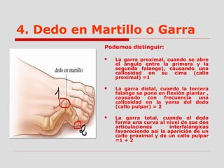 4. Dedo en Martillo o Garra
Podemos distinguir:
 La garra proximal, cuando se abre
el ángulo entre la primera y la
segunda falange), causando una
callosidad en su cima (callo
proximal) =1
 La garra distal, cuando la tercera
falange se pone en flexión plantar ,
causando con frecuencia una
callosidad en la yema del dedo
(callo pulpar) = 2
 La garra total, cuando el dedo
forma una curva al nivel de sus dos
articulaciones interfalángicas
favoreciendo así la aparición de un
callo proximal y de un callo pulpar
=1 + 2
 