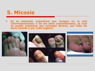 5. Micosis
 Es la infección superficial por hongos en la piel
(dermatomicosis) o en las uñas (onicomicosis), la cual
se puede ocasionar por contagio directo, por falta de
buen secado o por mala higiene.
 
