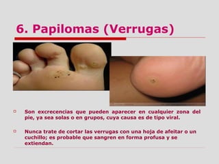 6. Papilomas (Verrugas)
 Son excrecencias que pueden aparecer en cualquier zona del
pie, ya sea solas o en grupos, cuya causa es de tipo viral.
 Nunca trate de cortar las verrugas con una hoja de afeitar o un
cuchillo; es probable que sangren en forma profusa y se
extiendan.
 