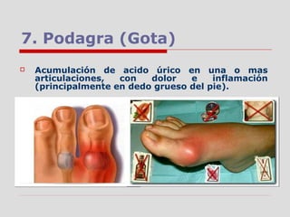 7. Podagra (Gota)
 Acumulación de acido úrico en una o mas
articulaciones, con dolor e inflamación
(principalmente en dedo grueso del pie).
 