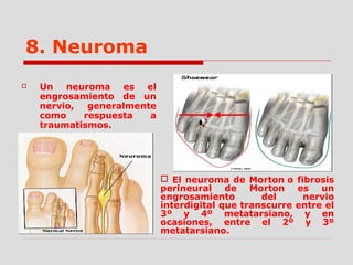8. Neuroma
 Un neuroma es el
engrosamiento de un
nervio, generalmente
como respuesta a
traumatismos.
 El neuroma de Morton o fibrosis
perineural de Morton es un
engrosamiento del nervio
interdigital que transcurre entre el
3º y 4º metatarsiano, y en
ocasiones, entre el 2º y 3º
metatarsiano.
 