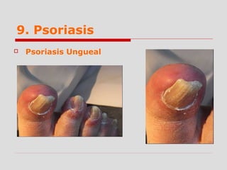 9. Psoriasis
 Psoriasis Ungueal
 