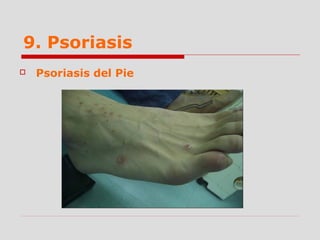 9. Psoriasis
 Psoriasis del Pie
 
