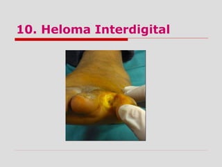 10. Heloma Interdigital
 