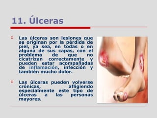 11. Úlceras
 Las úlceras son lesiones que
se originan por la pérdida de
piel, ya sea, en todas o en
alguna de sus capas, con el
problema de que no
cicatrizan correctamente y
pueden estar acompañadas
de inflamación, infección y
también mucho dolor.
 Las úlceras pueden volverse
crónicas, afligiendo
especialmente este tipo de
úlceras a las personas
mayores.
 