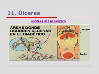 11. Úlceras
ULCERAS PIE DIABETICO
 