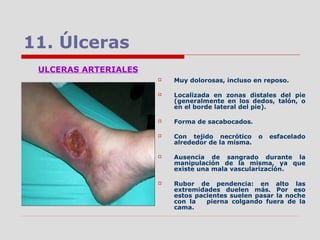 11. Úlceras
ULCERAS ARTERIALES
 Muy dolorosas, incluso en reposo.
 Localizada en zonas distales del pie
(generalmente en los dedos, talón, o
en el borde lateral del pie).
 Forma de sacabocados.
 Con tejido necrótico o esfacelado
alrededor de la misma.
 Ausencia de sangrado durante la
manipulación de la misma, ya que
existe una mala vascularización.
 Rubor de pendencia: en alto las
extremidades duelen más. Por eso
estos pacientes suelen pasar la noche
con la pierna colgando fuera de la
cama.
 