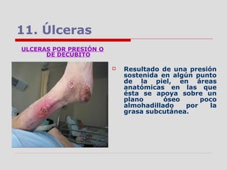 11. Úlceras
ULCERAS POR PRESIÓN O
DE DECÚBITO
 Resultado de una presión
sostenida en algún punto
de la piel, en áreas
anatómicas en las que
ésta se apoya sobre un
plano óseo poco
almohadillado por la
grasa subcutánea.
 