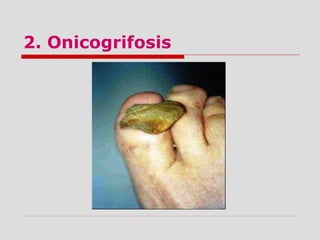 2. Onicogrifosis
 