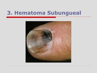 3. Hematoma Subungueal
 