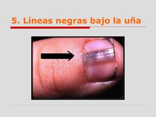 5. Líneas negras bajo la uña
 