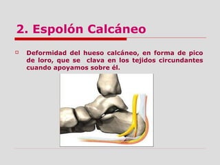 2. Espolón Calcáneo
 Deformidad del hueso calcáneo, en forma de pico
de loro, que se clava en los tejidos circundantes
cuando apoyamos sobre él.
 