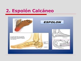 2. Espolón Calcáneo
 