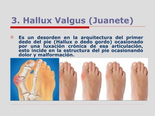 3. Hallux Valgus (Juanete)
 Es un desorden en la arquitectura del primer
dedo del pie (Hallux o dedo gordo) ocasionado
por una luxación crónica de esa articulación,
esto incide en la estructura del pie ocasionando
dolor y malformación.
 