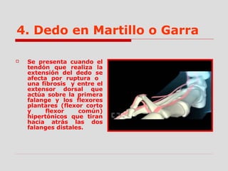 4. Dedo en Martillo o Garra
 Se presenta cuando el
tendón que realiza la
extensión del dedo se
afecta por ruptura o
una fibrosis y entre el
extensor dorsal que
actúa sobre la primera
falange y los flexores
plantares (flexor corto
y flexor común)
hipertónicos que tiran
hacia atrás las dos
falanges distales.
 