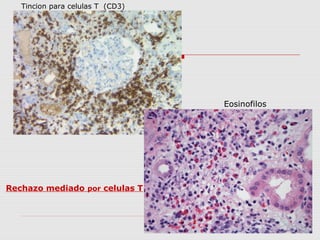 Tincion para celulas T (CD3) 
Rechazo mediado por celulas T 
Eosinofilos 
 