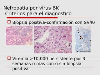 Nefropatia por virus BK 
Criterios para el diagnostico 
 Biopsia positiva-confirmacion con SV40 
 Viremia >10.000 persistente por 3 
semanas o mas con o sin biopsia 
positiva 
 
