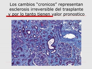 Los cambios “cronicos” representan 
esclerosis irreversible del trasplante 
y por lo tanto tienen valor pronostico 
 