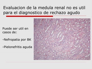 Evaluacion de la medula renal no es util 
para el diagnostico de rechazo agudo 
Puede ser util en 
casos de: 
-Nefropatia por BK 
-Pielonefritis aguda 
 