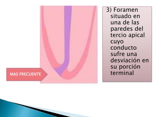 3) Foramen
situado en
una de las
paredes del
tercio apical
cuyo
conducto
sufre una
desviación en
su porción
terminalMAS FRECUENTE