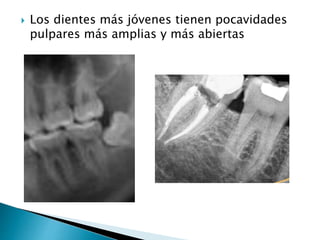  Los dientes más jóvenes tienen pocavidades
pulpares más amplias y más abiertas