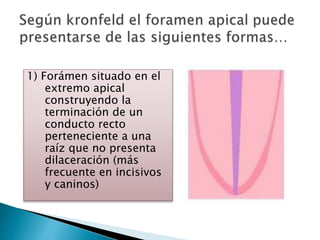 1) Forámen situado en el
extremo apical
construyendo la
terminación de un
conducto recto
perteneciente a una
raíz que no presenta
dilaceración (más
frecuente en incisivos
y caninos)