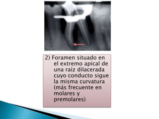 2) Foramen situado en
el extremo apical de
una raíz dilacerada
cuyo conducto sigue
la misma curvatura
(más frecuente en
molares y
premolares)