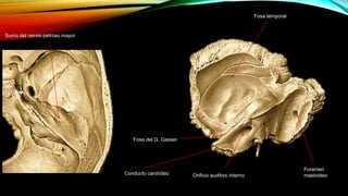 Orificio auditivo interno
Fosa del G. Gasser
Foramen
mastoideoConducto carotídeo
Fosa temporal
Surco del nervio petroso mayor
 